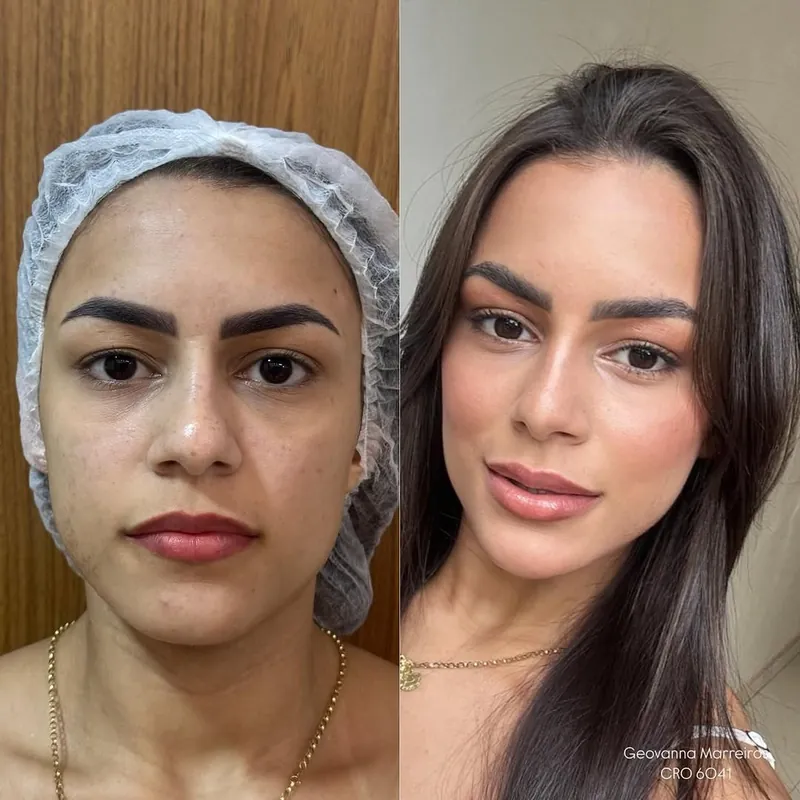 Antes e depois de harmonização facial feminina