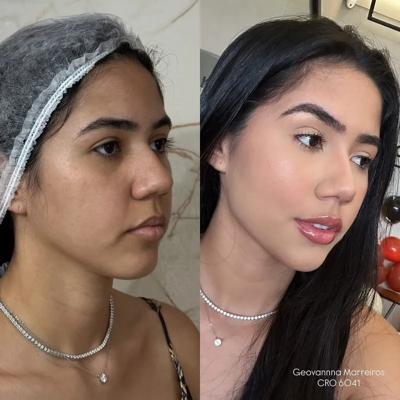 Antes e depois de full face em paciente jovem